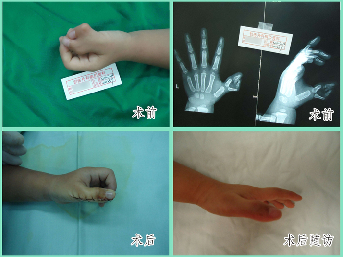 为避免功能和形态的进行性加重,医生建议宜尽早进行手术治疗.